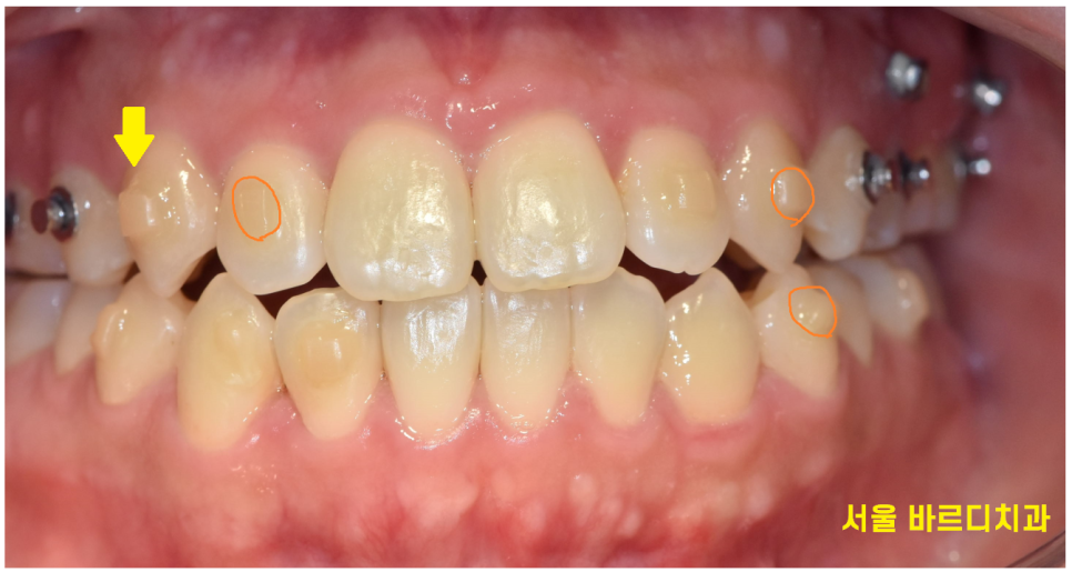 인비절라인 투명교정 오해 편하긴 하지만 치아를 움직이기에 관련 이미지 4