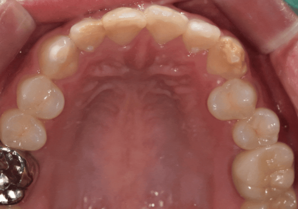 고덕역 치과 반점치 얼룩덜룩한 치아, 치료 실패 줄이는 5가지 기준 관련 이미지 5