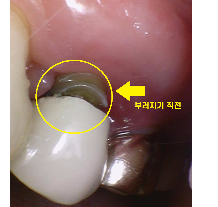 덕풍동 치과 씹을때 통증 임플란트로 극복했습니다. 관련 이미지 3