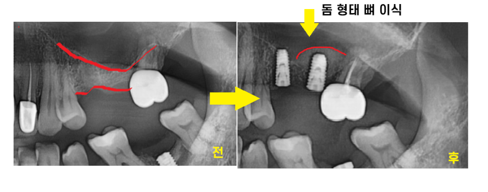 상일동 임플란트 상악동 거상술을 동반한 수술 증례 관련 이미지 9