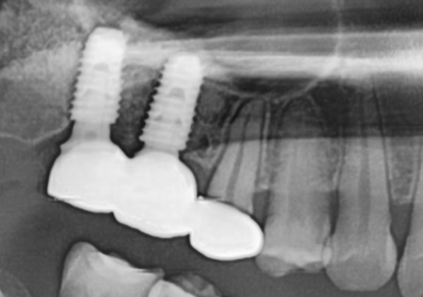 Myeongil-dong Implant Treatment in Your 20s: The Reason It Ended Up Requiring Bone Grafting After Thinking, “I’m Young, So It’ll Be Fine” image 14