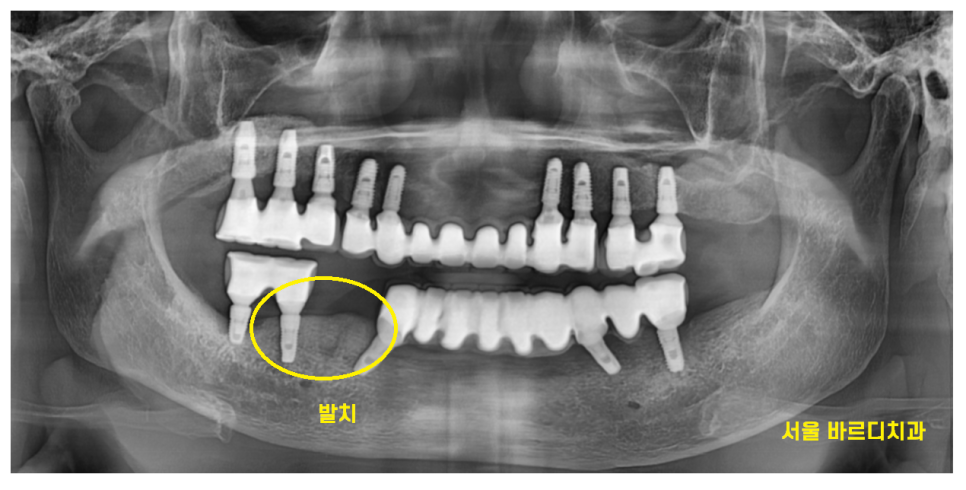 덕소 치과 발치 후 당일 뼈이식의 중요성 설명드립니다!! 관련 이미지 7