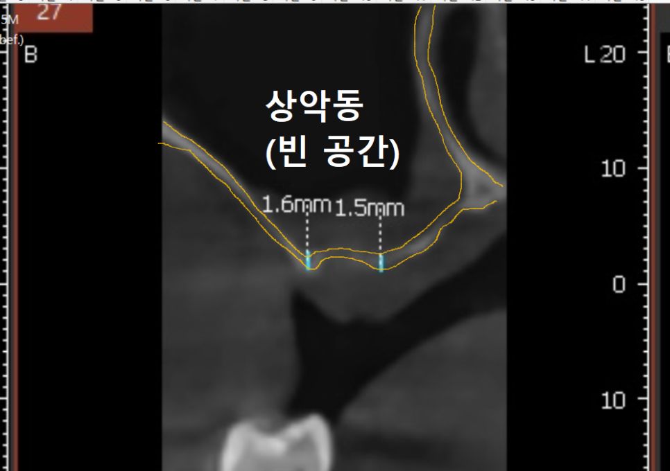 Myeongil-dong Implant Treatment in Your 20s: The Reason It Ended Up Requiring Bone Grafting After Thinking, “I’m Young, So It’ll Be Fine” image 9