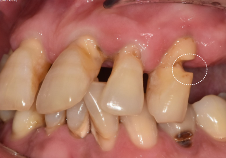 위 턱 전체 임플란트 vs 부분 틀니, 나에게 꼭 필요한 치료법 찾기 관련 이미지 3