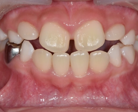When Should My Child Start Orthodontic Treatment? When to Begin Now vs. When It Is Fine to Wait image 6