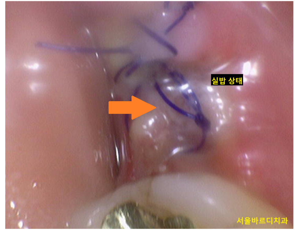 임플란트 수술 통증과 붓기 시기별 회복 과정 총정리! 관련 이미지 2