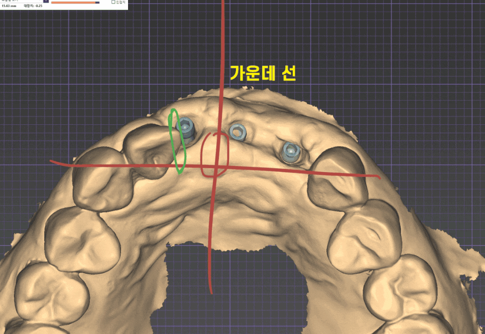 상일동역 치과 윗니 앞니 흔들림 임플란트로 심미까지 잡았습니다. 관련 이미지 1