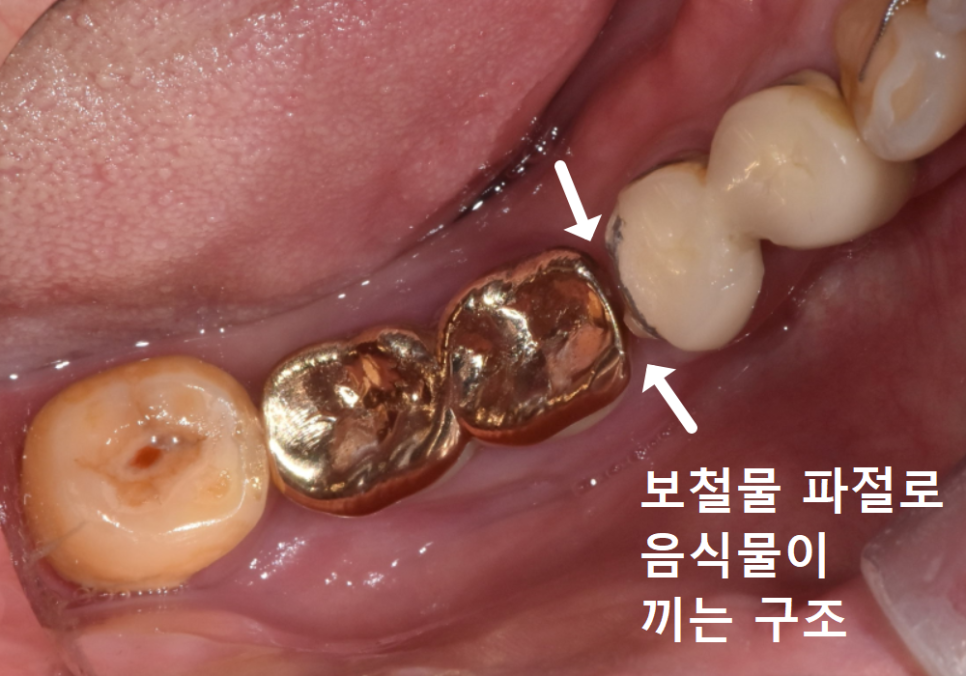 오래된 임플란트, 흔들림과 통증, 어떻게 하면 더 건강하게 쓸 수 있을까? 관련 이미지 7