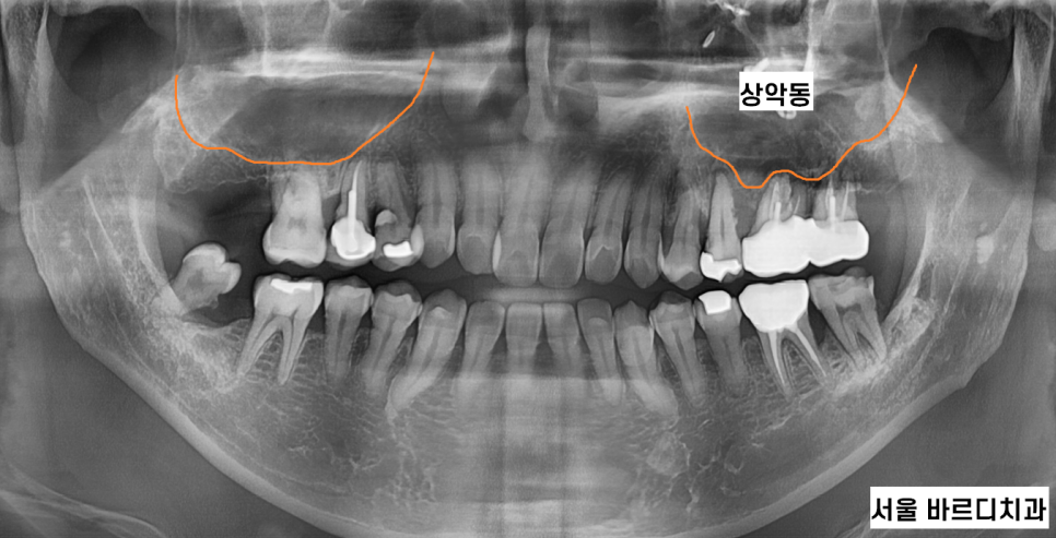 상악동염 이비인후과 치료 후 임플란트를 해야할 수 있습니다. 관련 이미지 4