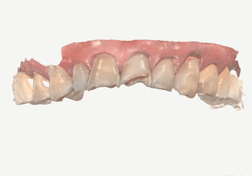 Gangdong-gu Dental Impressions: Are You Still Biting Down for 5 Minutes? We’ll Make It Comfortable with an Intraoral Scanner! image 6