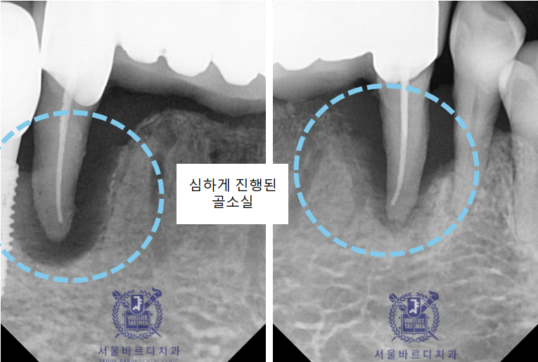 고덕동치과 서울바르디치과 전치부 및 구치부 임플란트 치료증례 #10 관련 이미지 2