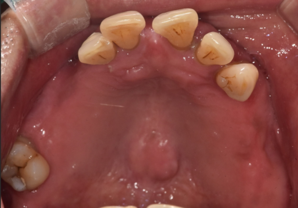 고덕동 앞니 보철, 브릿지와 싱글 크라운, 어떤 선택이 나에게 더 유리할까? 관련 이미지 4