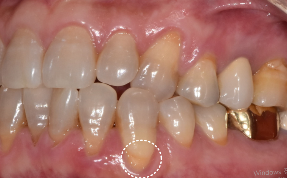 잇몸 내려감으로 길어진 치아, 방치하면 안 되는 원인, 증상, 이유 관련 이미지 3