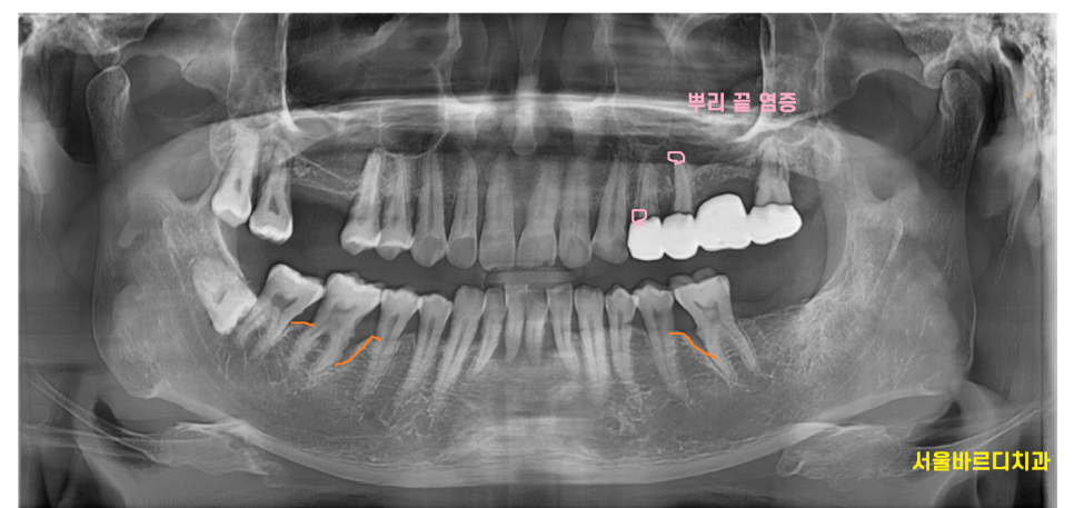 고덕동 치과 검진 시 이게 빠지면 말짱 도루묵!!! 관련 이미지 3