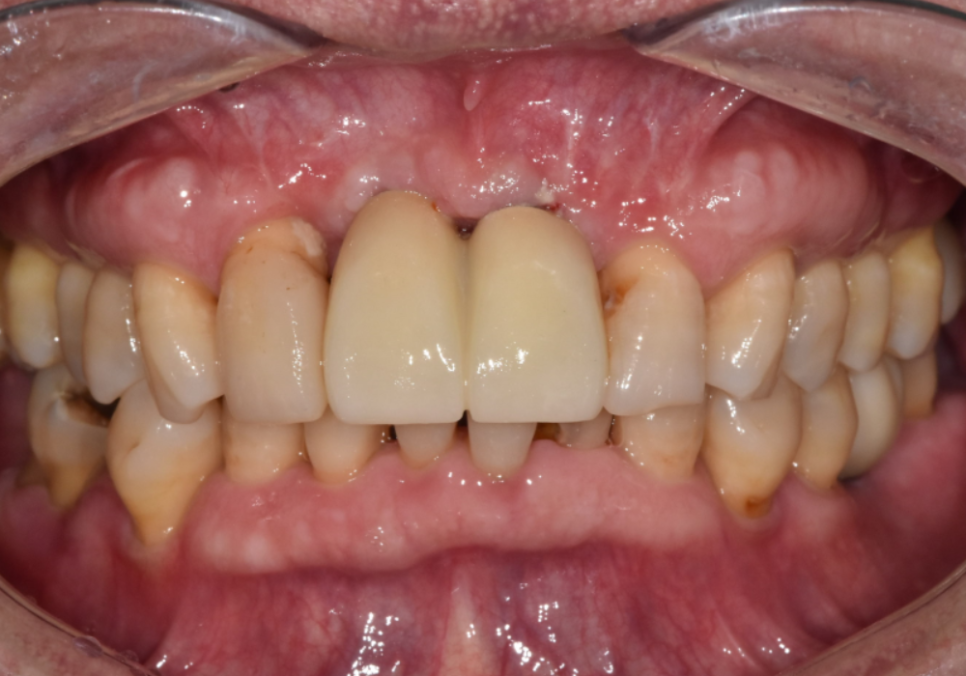 대문니 빠짐, 앞니 빠졌을 때 브릿지와 임플란트 중 나에게 맞는 선택은? 관련 이미지 17