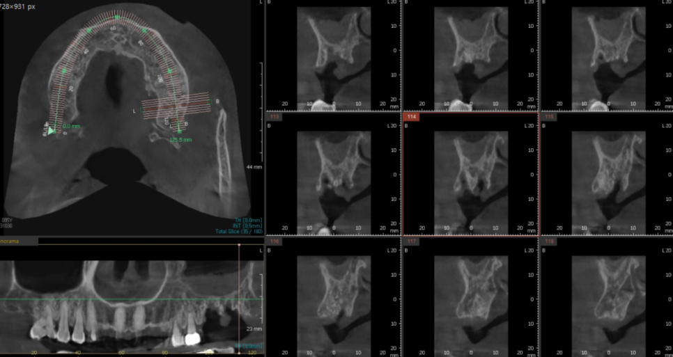 고덕동 치과 임플란트 거부감이 있었지만 네비게이션 수술법으로 해결했습니다. 관련 이미지 6