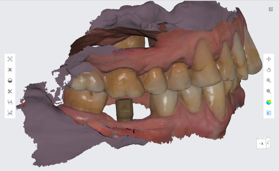 서울바르디치과 상하악 대구치 네비게이션 임플란트 치료증례 #4 관련 이미지 19