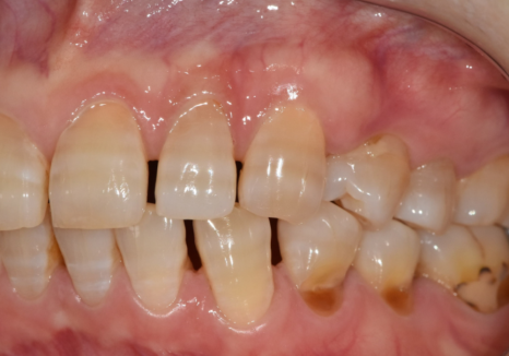 50대 라미네이트, 앞니 벌어짐과 변색 고민 이렇게 해결했습니다. 관련 이미지 5