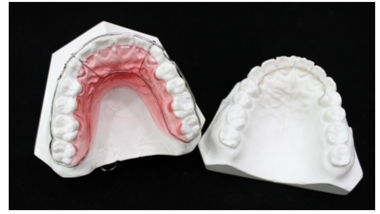 치아교정 재교정 다시 삐뚤어진 치아 원인과 해결방법은? 관련 이미지 1