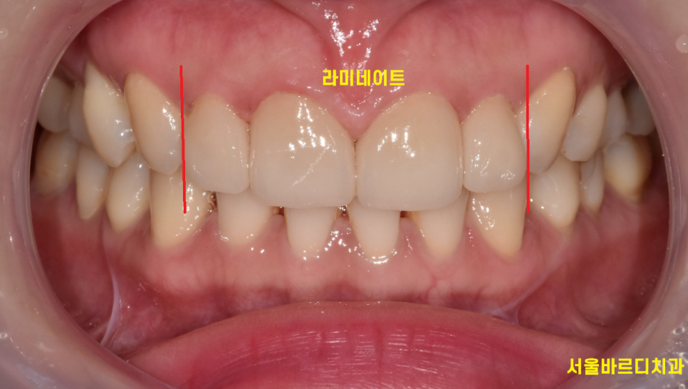 왜소치 라미네이트 작은 치아 콤플렉스 말끔하게 극복해요!! 관련 이미지 8