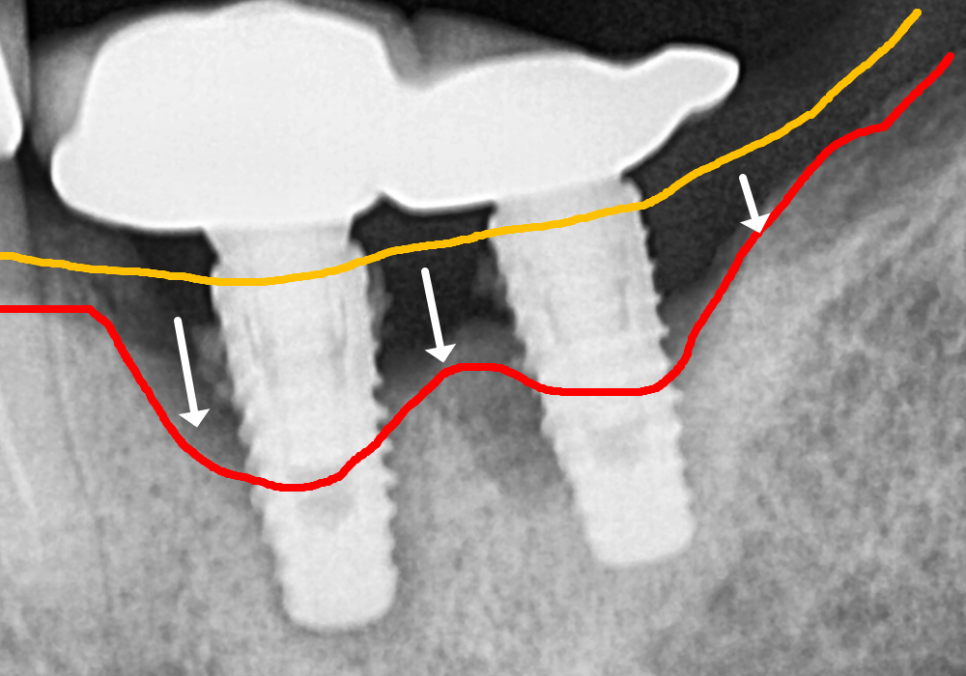 애써 심어둔 임플란트, 교체해야 된다구요? 냄새가 난다면 확인해보세요. 관련 이미지 7