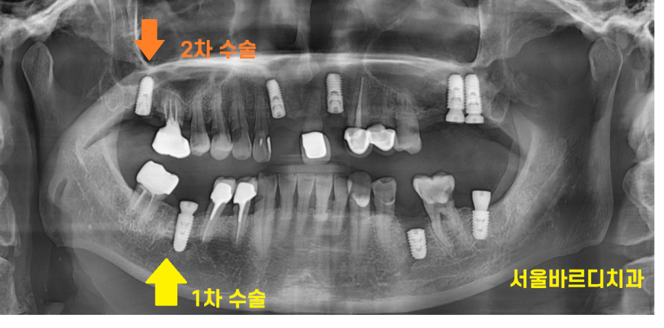 임플란트 2차 수술 과정 아직도 안끝났어요? 죄송합니다!! 관련 이미지 3