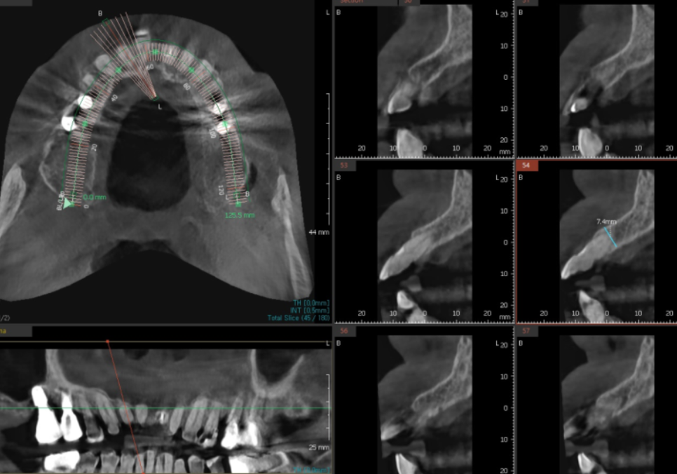 상일동역 치과 앞니 임플란트 기간 때문에 망설이신다면 꼭 보세요. 관련 이미지 6