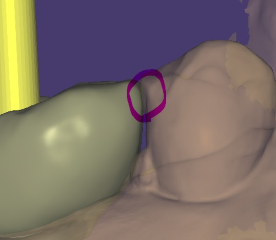 임플란트 볼씹힘 왜 생기고 어떻게 해결할까? 관련 이미지 4