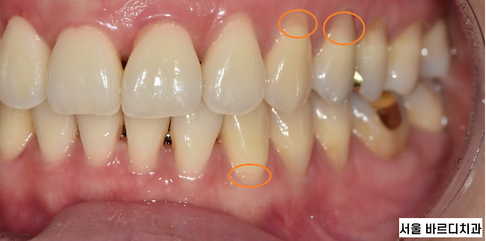 상일동역 치아교정 부작용 꼭 알아보고 대처하세요!!! 관련 이미지 2