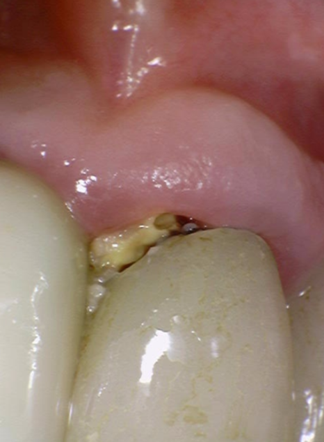 음식물 끼임, 거뭇한 무언가 보인다면? 이미 늦었을 수 있습니다. 관련 이미지 3