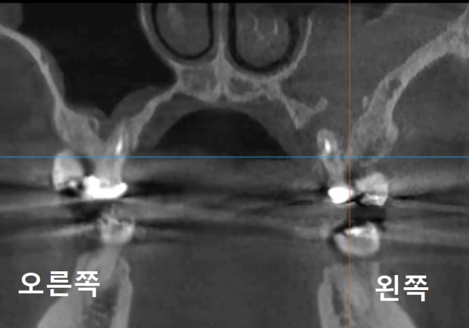 Sinusitis Caused by Teeth: Why Do You Tell Me to Go to the Dentist When My Nose Hurts? image 6