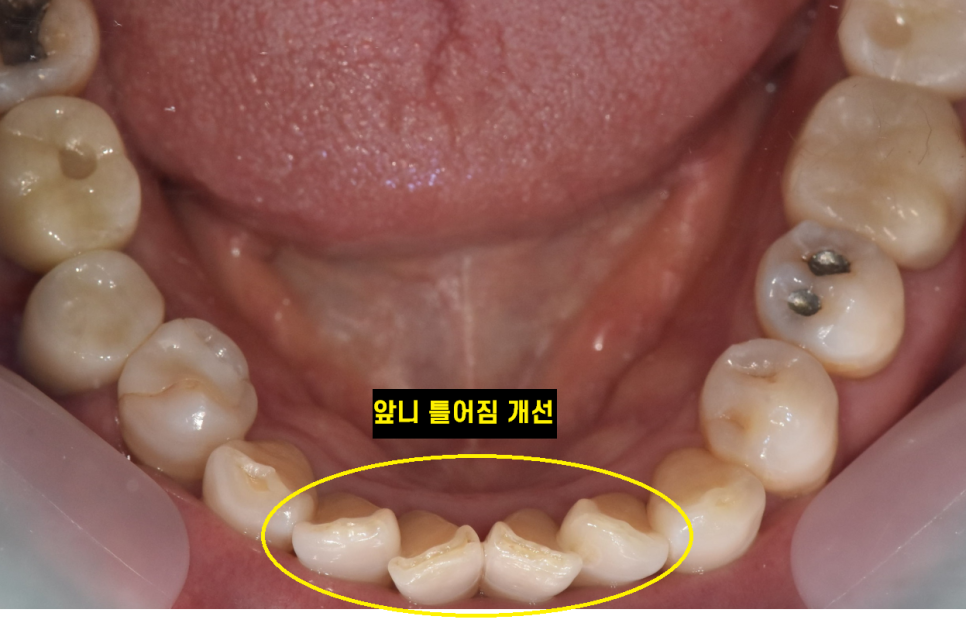 교정과 임플란트 동시에 해야한다면? 순서는? 관련 이미지 3