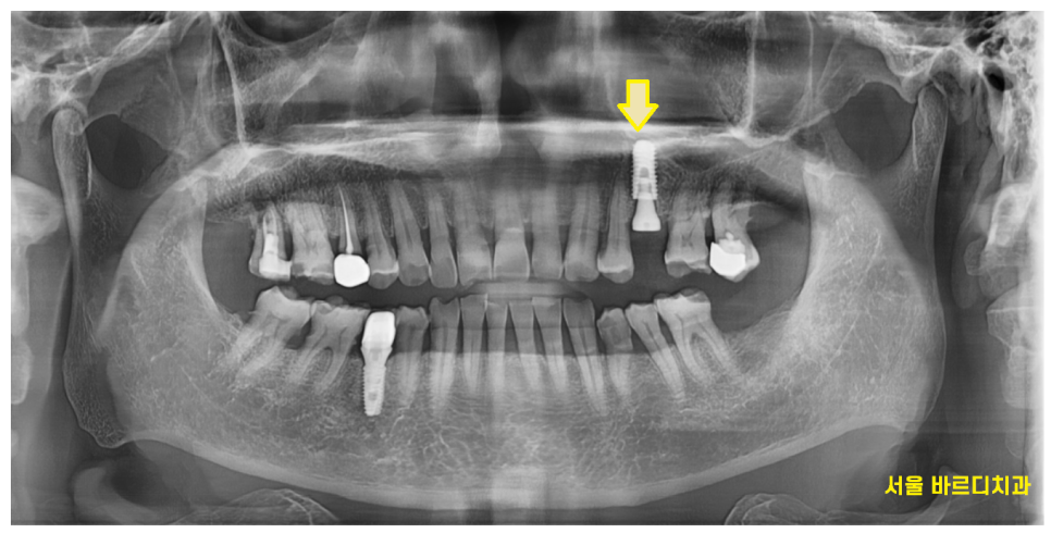 미사 임플란트 금니 빠짐 보철물 빠졌을 때 대처법 알려드려요 관련 이미지 5