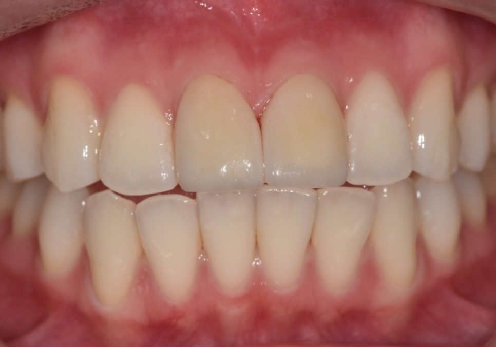 절단교합으로 인한 앞니 레진 깨짐, 교정 없이 해결한 사례 관련 이미지 9