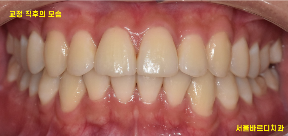 고덕동 치아교정 유지장치는 부정교합 재발을 막기위한 필수입니다! 관련 이미지 2