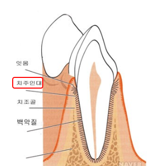 임플란트 고름 나오고 통증이 느껴질때 어떻게 해야할까요? 관련 이미지 4