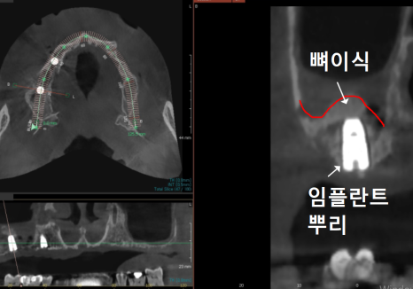뼈가 없어서 안 된다구요? 70대 당뇨 무치악 환자분의 전체 임플란트 사례 관련 이미지 10