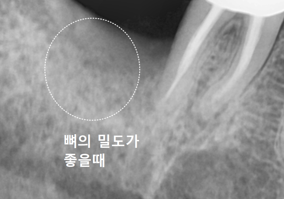 강동구 임플란트 기간, 사람마다 왜 다를까? 즉시식립과 지연식립의 결정적 차이 관련 이미지 1