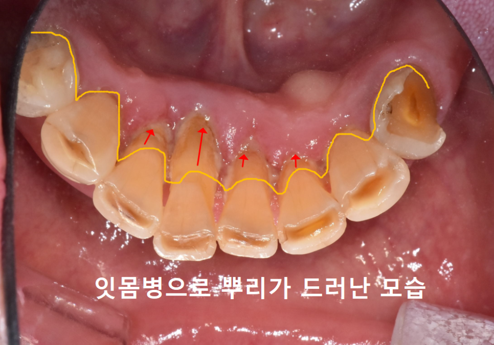 뿌리만 남은 치아, 그대로 두면 왜 위험할까요? 고덕동 전체 임플란트 재건 사례 관련 이미지 9