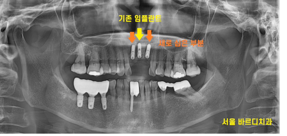 미사 임플란트 보철 새로하고 연결했습니다. 관련 이미지 7