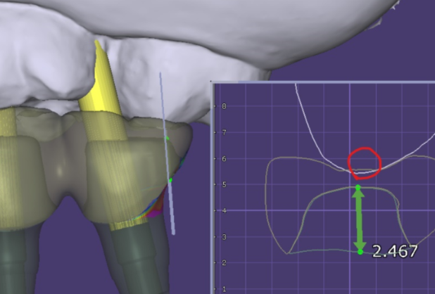 상일동역 치과에서 알려드리는 임플란트 수술과정 대공개 관련 이미지 10