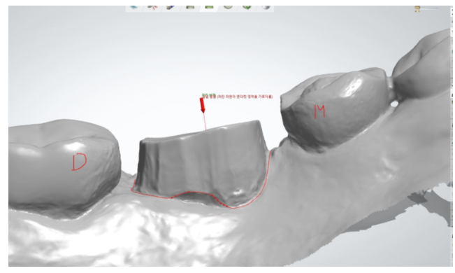 강동구 치과 약먹는게 많은데 임플란트 수술 할 수 있나요?? 관련 이미지 5