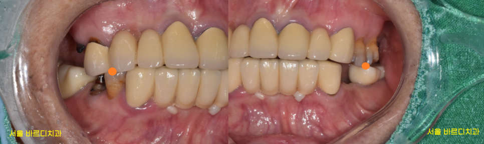 명일동 치과 임플란트 치료 기간 얼마나 걸릴까요??? 관련 이미지 3