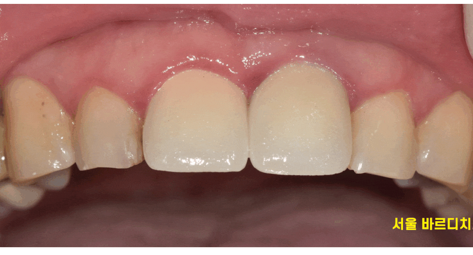 살짝 깨진 앞니 레진과 라미네이트 갈림길 어떤게 더 좋을까? 관련 이미지 1