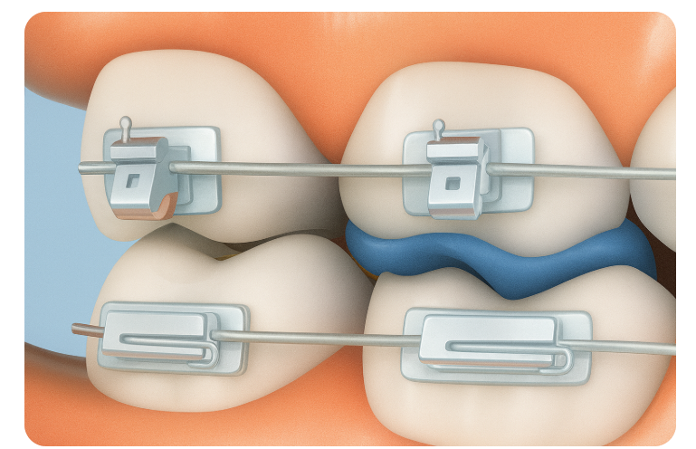 Blue Bite Blocks for Orthodontic Treatment: Everything You Need to Know, Organized image 5