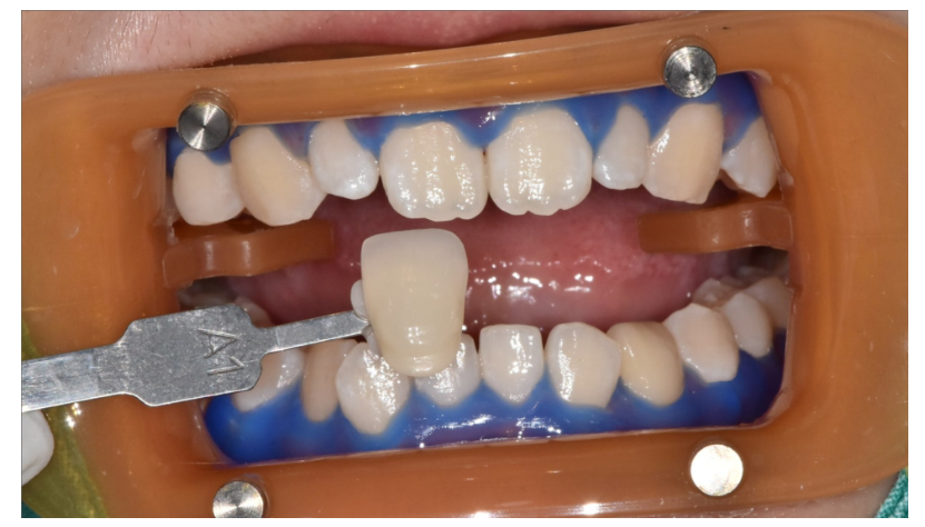 상일동 치아 미백 결혼 전 받아야하는 이유 3가지 관련 이미지 4