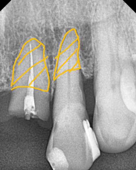 상일동역 치과 앞니 임플란트 기간 때문에 망설이신다면 꼭 보세요. 관련 이미지 5