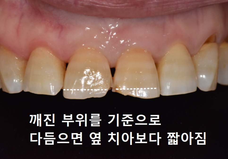 앞니 끝부분 깨짐, 다듬기, 레진, 라미네이트? 어떤 치료가 나에게 적합할까? 관련 이미지 6