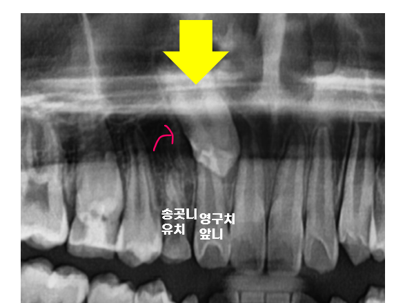 Pediatric Orthodontic Treatment for Impacted Canines Is Needed to Guide Proper Eruption. image 4