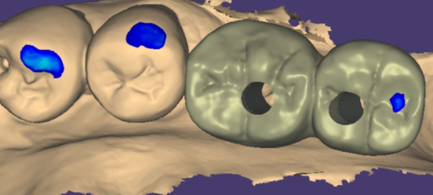 상일동역 치과에서 알려드리는 임플란트 수술과정 대공개 관련 이미지 11
